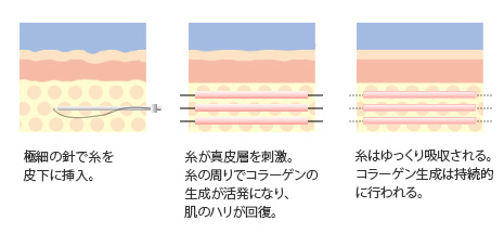 うるおいUPコラーゲンリフト 美肌再生のしくみ