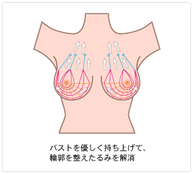 バストアップフェザーリフト