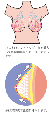 バストアップ フェザーリフト