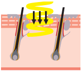 ダイオードレーザー脱毛のしくみ