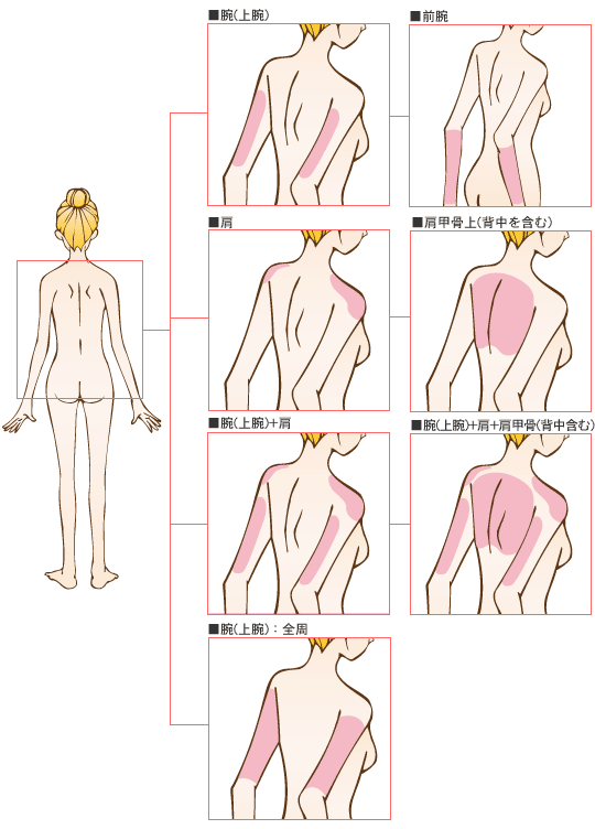 腕〜肩の脂肪吸引