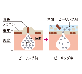 ケミカルピーリング