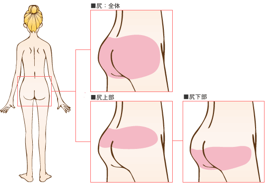 尻の脂肪吸引