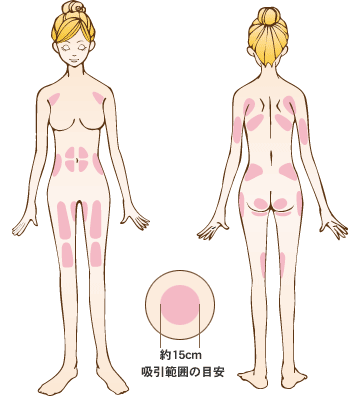 クイック脂肪吸引　対象部位