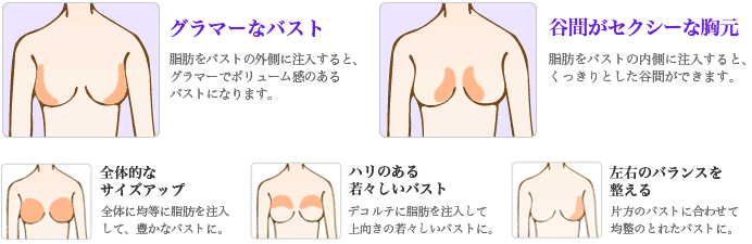 バスト脂肪注入の位置