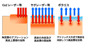 ポラリスのメカニズム