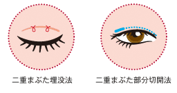 二重まぶた埋没法と部分切開法