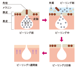 ピーリング