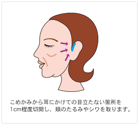 小切開法によるフェイスリフト