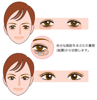 切らないたるみ取り「目の下の脱脂」