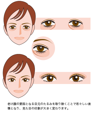 目の上・下のたるみ取り