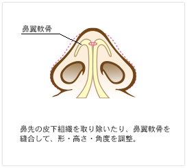 鼻先の幅を細くし高くする