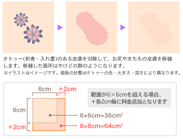 皮膚移植法によるタトゥー(刺青・入れ墨)除去