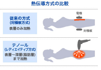 テノールによる高周波治療のしくみ