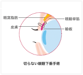 切らない眼瞼下垂