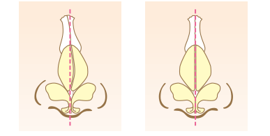 斜鼻修正術で鼻筋をまっすぐに