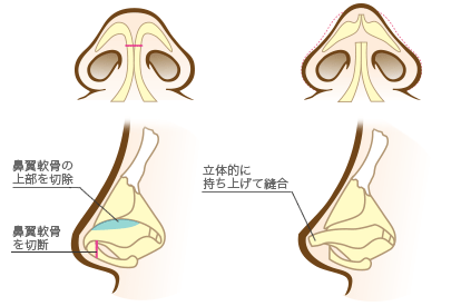 鼻尖形成術3D法