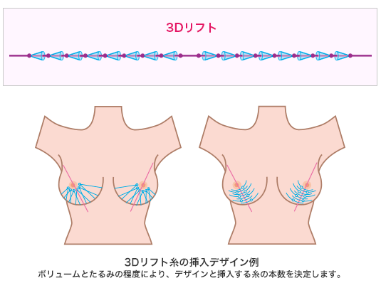 バストアップ3Dリフトの特徴