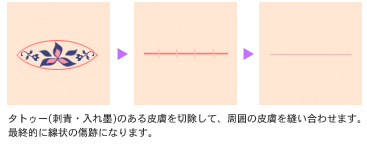 切除法によるタトゥー(刺青・入れ墨)除去