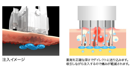 水光注射