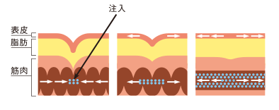 シワ取り注射