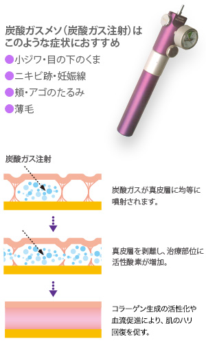 炭酸ガス注射(炭酸メソ)