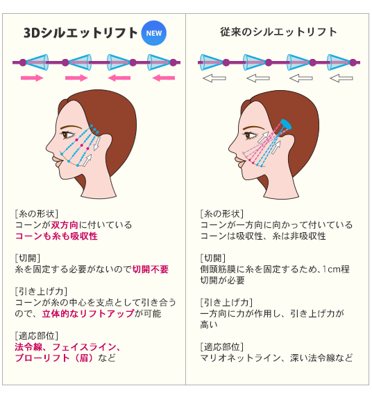 3Dリフトとシルエットリフト