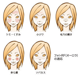 フォトRFの適応