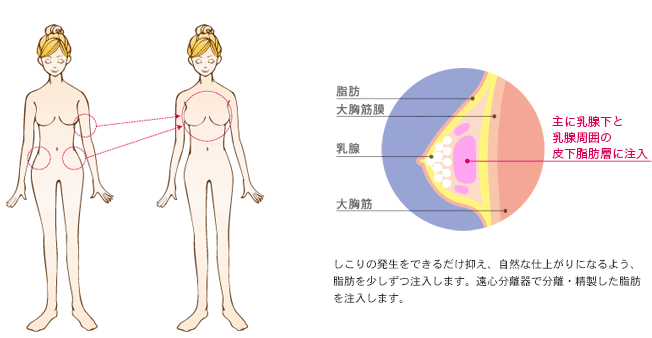 脂肪吸引・注入部位