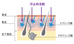 注射によるワキガ・ワキ多汗症の治療