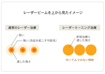 肝斑治療レーザートーニング