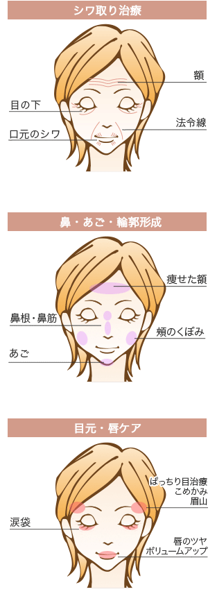 ヒアルロン酸注入の適応部位