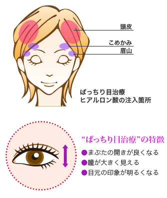 ヒアルロン酸注入によるぱっちり目治療