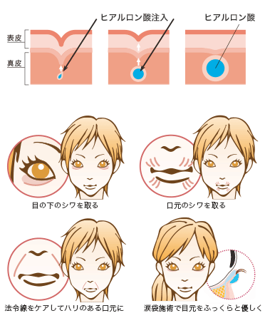 ヒアルロン酸注入の特徴