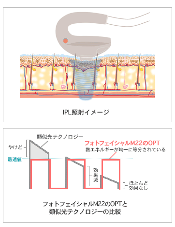 フォトフェイシャルM22のメカニズム