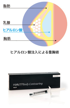 ヒアルロン酸注入による豊胸術