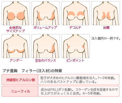 プチ豊胸 注入箇所/フィラーの特徴