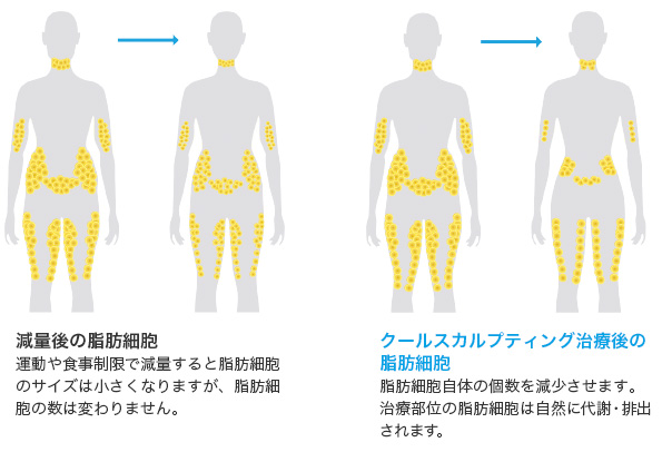 クールスカルプティング治療後の脂肪細胞