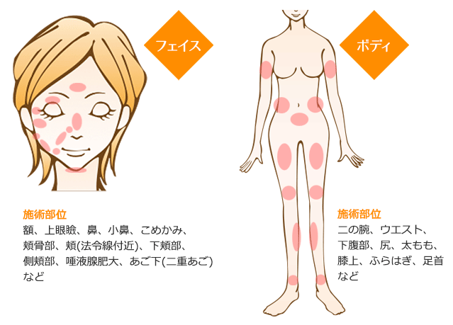 BNLS注射 施術部位