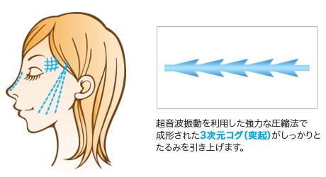 強力な牽引力の「溶ける糸」ウルトラフィルハイパーリフト