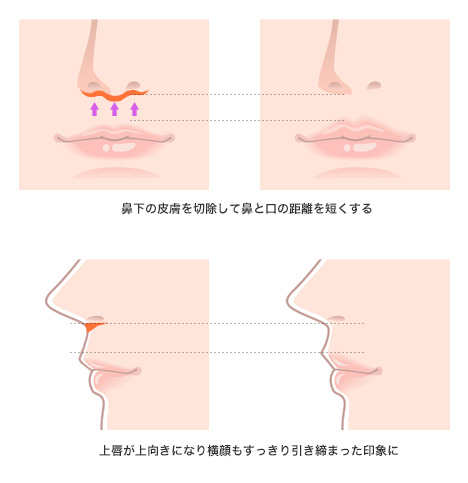 人中短縮術(リップリフト、上口唇短縮)