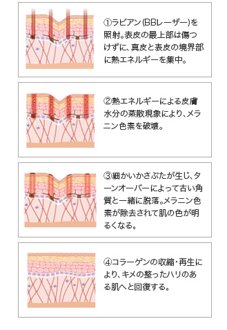 ラビアンによるレーザー治療のしくみ