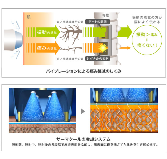 痛みを軽減するサーマクール独自のシステム