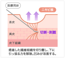 サブシジョン