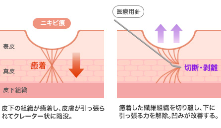 サブシジョン