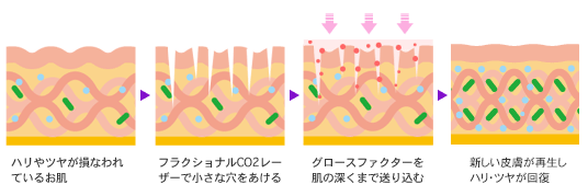 フラクショナルCO2レーザーと皮膚再生カクテルのコンビネーション