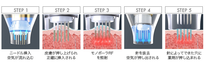 ポテンツァのドラッグデリバリーシステム