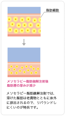 メソセラピー脂肪融解注射