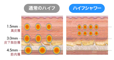 ハイフシャワーは超音波を皮膚の浅い層に照射