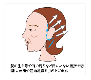 フェイスリフト